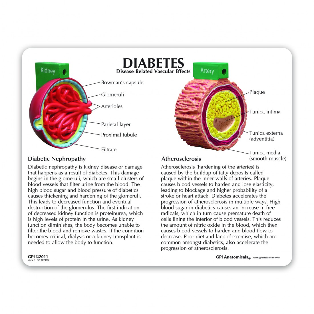 4-Piece Diabetes - Model #4011 - GPI Anatomicals