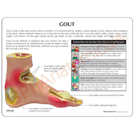 gout in heel bone