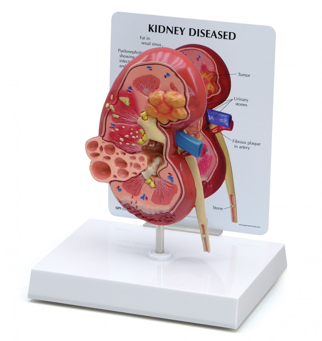 Kidney Normal/Pathology - Model #3260 - GPI Anatomicals