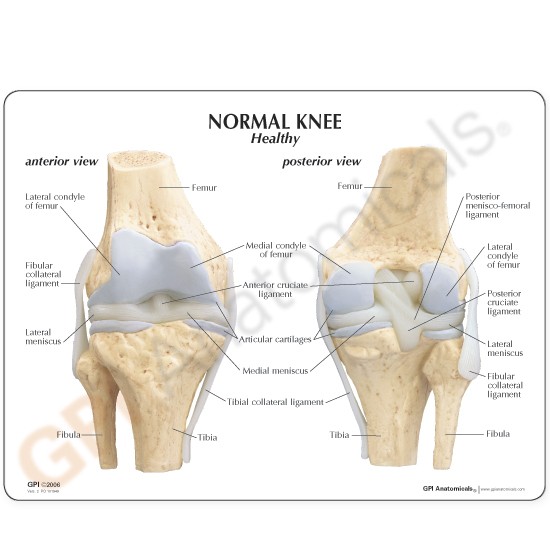 4-Stage Osteoarthritic Knee