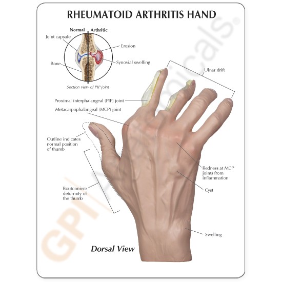 az interphalangealis ízület rheumatoid arthritise)