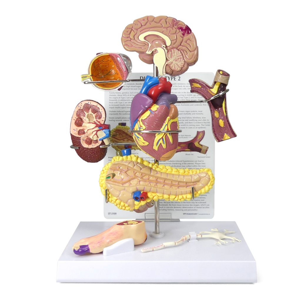 Type II Diabetes Set - Model #4010 - GPI Anatomicals